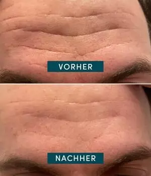 Apricot Mini Facial Patches Niacinamide its a skin-vestment 24Stück