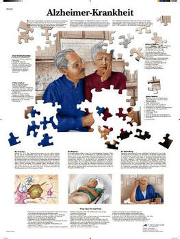 3B Scientific Alzheimer-Krankheit VR0628UU