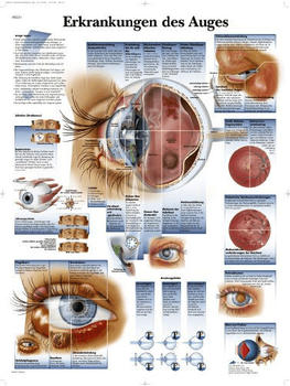 3B Scientific Erkrankungen des Auges VR0231L