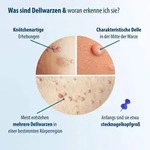 EVOLSIN Dellwarzen Mittel L&ouml;sung 5 ml