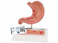 3B Scientific Menschliche Anatomie - Magen mit Magengeschwüren + kostenlose Anatomie